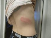 Корреспондент "МБХ.Медиа" получил травму легкого после удара дубинкой полицейского